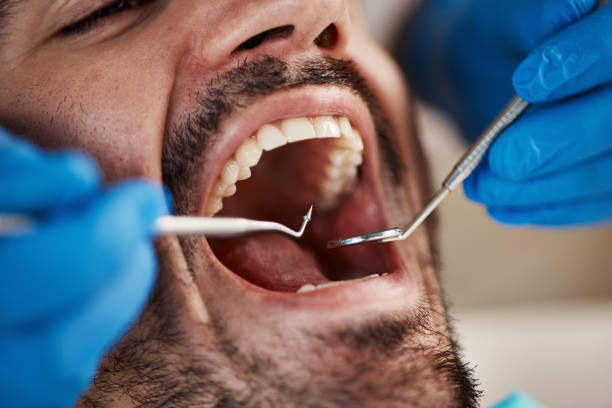 Oral Cancer Screening in Dupont, WA